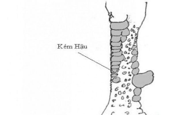 vảy kém hậu